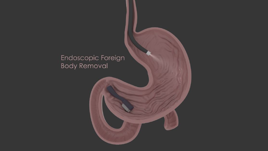 A Patient's Guide to Endoscopic Foreign Body Removal